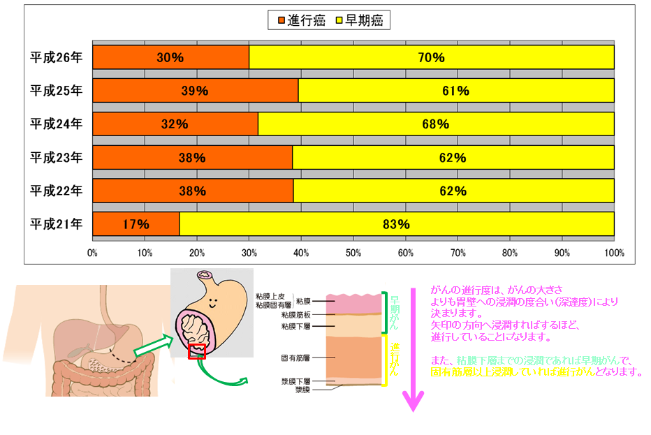 胃癌手術施行患者における、進行がんと早期がんの割合のグラフ